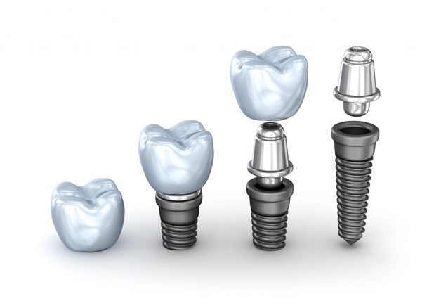 Why Are Dental Implants Better than Other Tooth Replacement Options?
